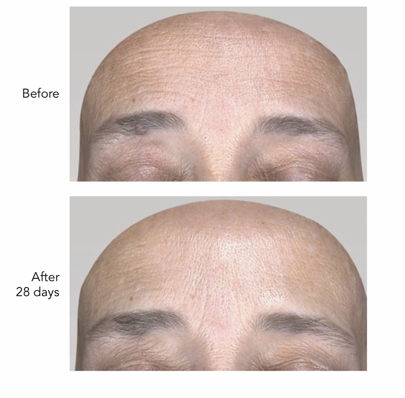 The results of smoothing wrinkles