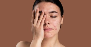 Уход за проблемной кожей: как очистить лицо и улучшить состояние кожи